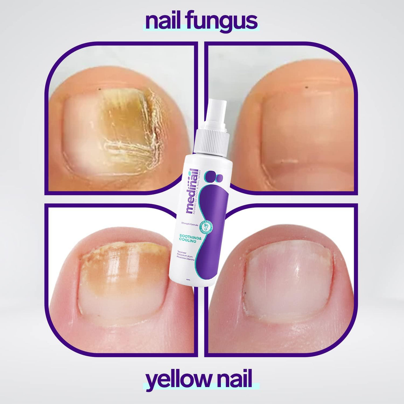 NAIL FUNGUS SPRAY
