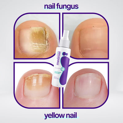 NAIL FUNGUS SPRAY